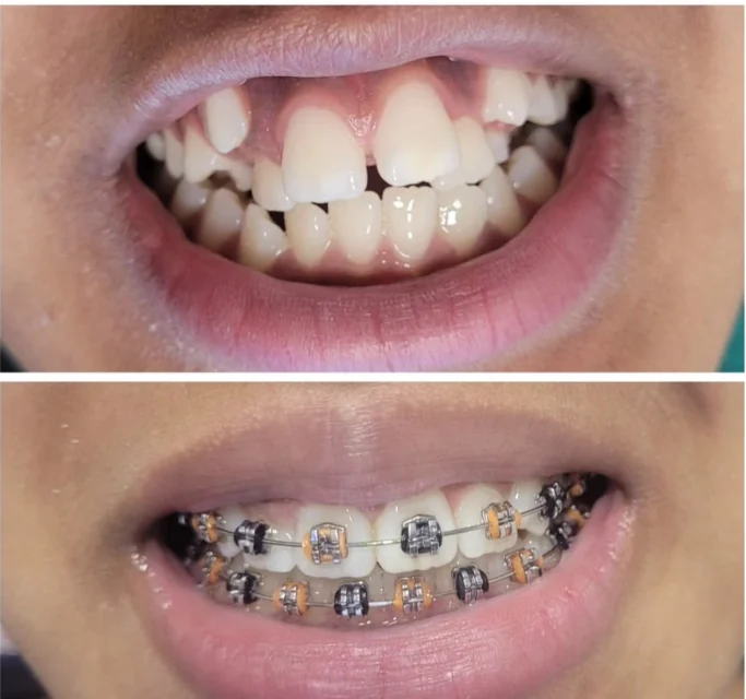 Fotografias do sorriso antes da colocação do aparelho e com aparelho ortodôntico